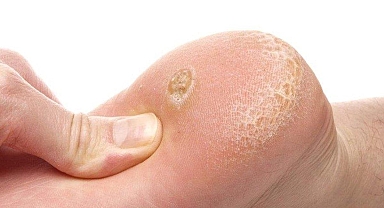 Nasır İçin Hangi Doktora Gidilir? Nasır İçin Hangi Bölüme Gidilmelidir? - Sağlık Haberleri